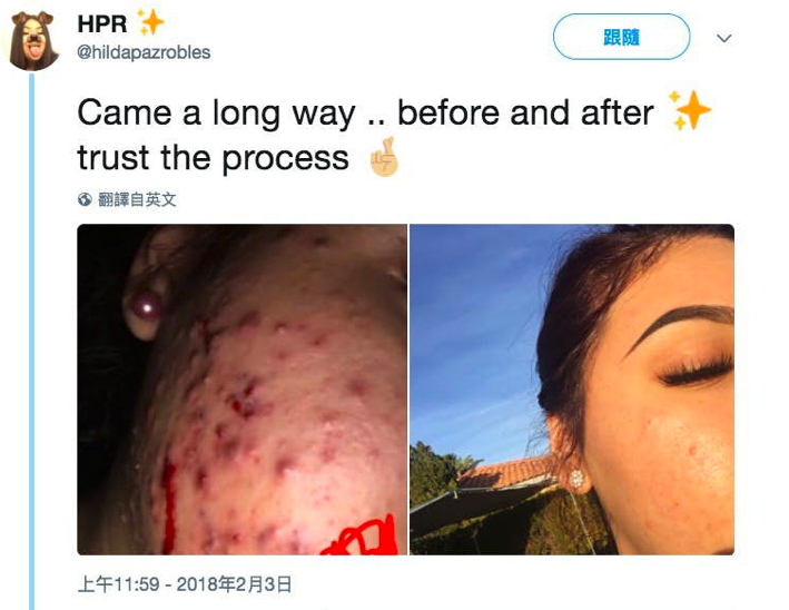 外国女生用天然蜂蜜绿茶成功祛痘