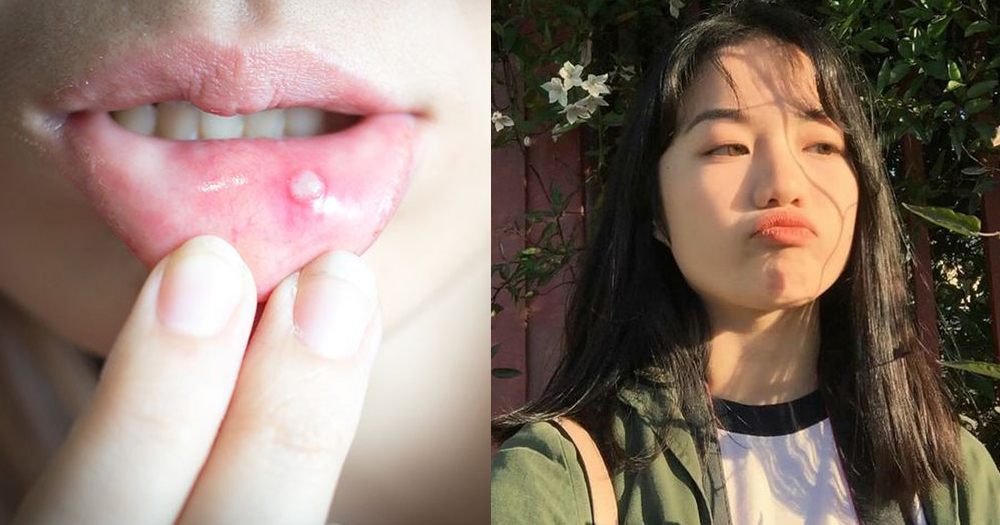 流感季节或新年期间大吃大喝热气食物都容易导致长Ulcer