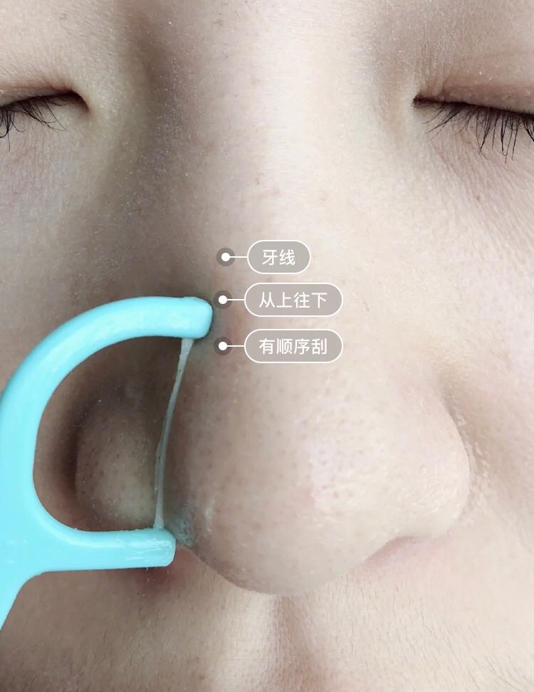 木瓜膏 牙线清除黑头