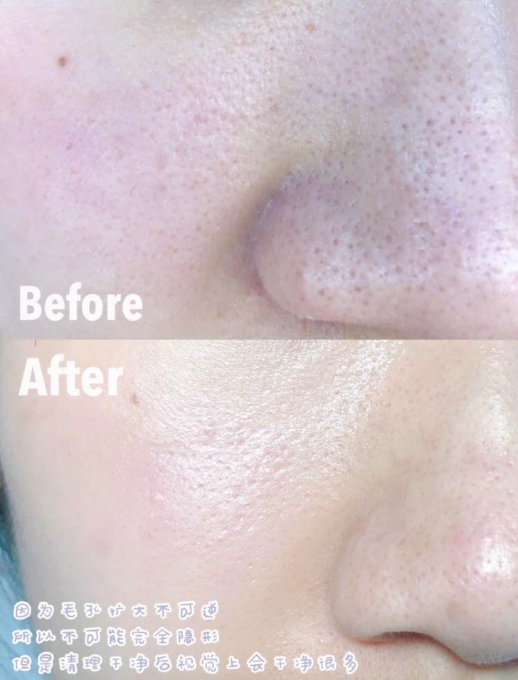 祛黑头 before & after