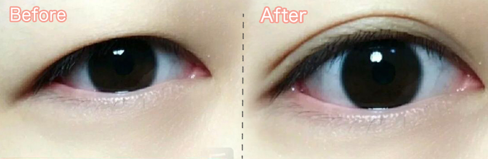 前后对比 单眼双眼皮