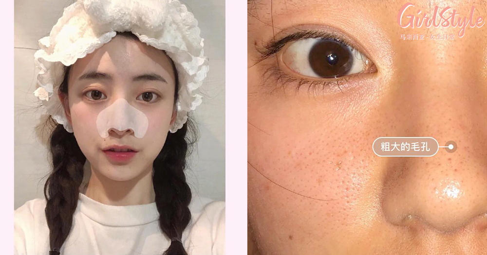 粗大毛孔 黑头粉刺