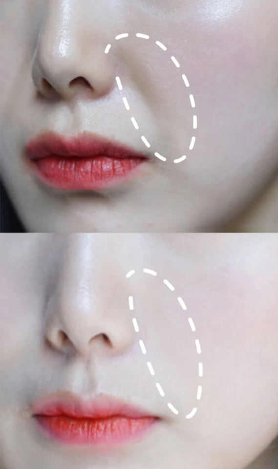 脸蛋上除了眼周细纹容易「显龄」，需要透过涂抹眼霜、按摩眼周防止细纹增生...法令纹的毁颜值效果也不容小觑，一定要趁早改善淡化！