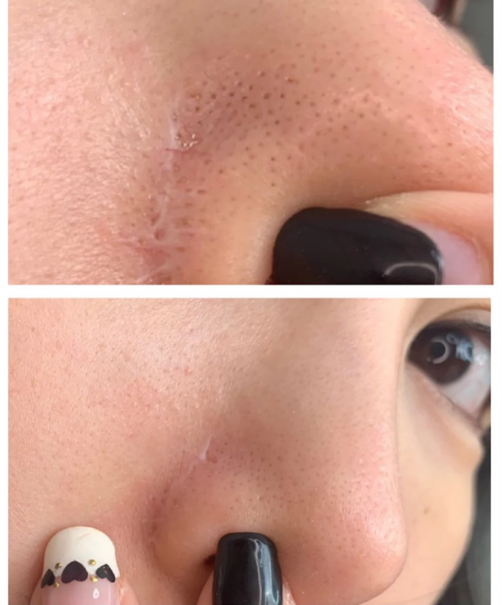 ✨2、去黑头神器好物 小红书上许多博主都强力推荐使用Johnson’s Baby Oil清楚黑头粉刺,效果据说很惊艳呢!清洁脸部肌肤后,用Johnson’s婴儿油浸湿化妆棉,敷在鼻头上约5-10分钟后会发现黑头油脂浮出来;之后可以再用指腹轻轻按摩鼻头,几分钟后擦掉被清出毛孔的小颗粒~轻松赶走草莓鼻!