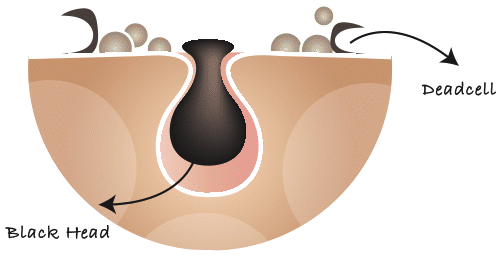 STEP 2 :毛孔通化去角质素 GlySal Glow Peel 基础卸妆洁面还不够,用毛孔通化去角质素来加强清洁功效,同时促进细胞新生、疏通毛孔、有效去除老废角质。