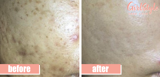 ✨ 给肌肤展开神救援，把毁颜值的「它们」统统DELETE！✨ PicoSpot疗程能够有效促进胶原蛋白再生、让肌肤更紧实透亮，同时针对性改善雀斑、黄褐斑、老年斑、胎记、痘印等色素沉着和长斑问题；绝对是爱美女生们的「最佳肌肤神救援」！