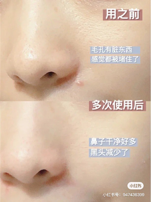 ✨ Papa Recipe 茄子清洁面膜 | RM26 - RM48 >> 链接 除了Innisfree火山泥、Kiehl's白泥面膜很火,Papa Recipe家的茄子清洁面膜也特别受韩国女生喜爱,在韩网收获TOP 1认可!连韩国欧尼女演员李多海也曾在个人社交平台上分享过哟~这款清洁面膜主打清洁、去闭口和控油补水,涂起来质地特别丝滑,内含颗粒也很细腻不会刮肤;敷完后洗净会感觉皮肤变嫩、提亮一阶,黑头粉刺也干净了很多!