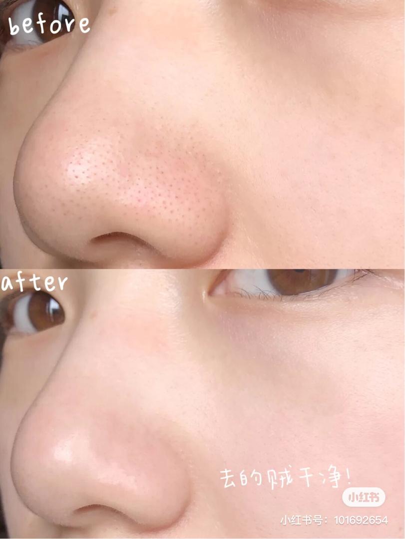 Emulsion Remover 去黑头喷雾 10