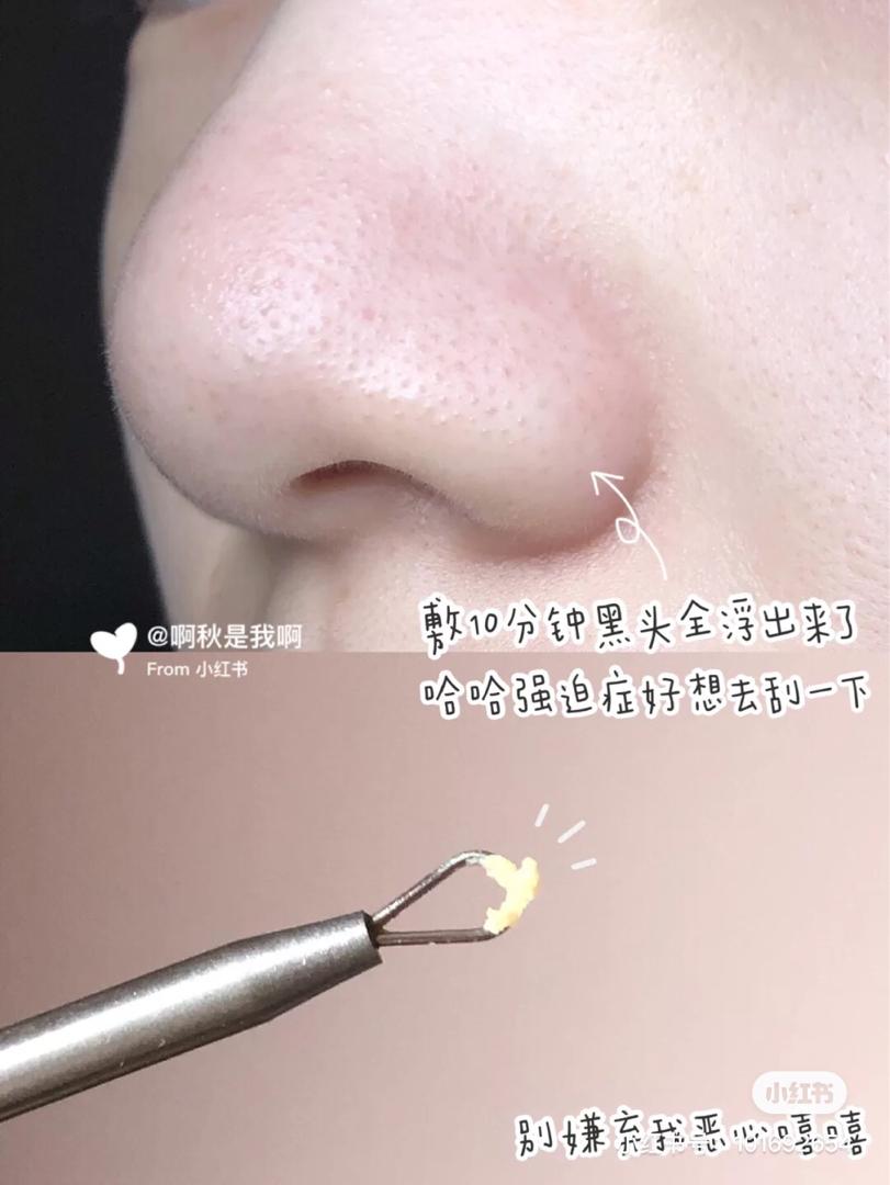 Emulsion Remover 去黑头喷雾 9