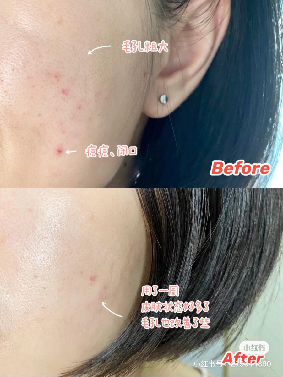 ✨COSRX清洁棉片 | RM45.20 >> 链接 这款COSRX家的清洁棉片在在韩国全民爱用的「化解APP」中曾多次被评选为「去角质好用产品TOP 3」～用法很简单，先使用棉片平滑那一面敷在要清洁的位置5-10分钟后，之后用棉片粗糙的另一面轻轻搓走浮出来的黑头粉刺脏污即可。棉片吸满了甜菜碱水杨酸酯、白柳树皮水等有效洁肤成分，可以很好疏通毛孔和控油，去角质的同时也带有舒缓作用，极力推荐油皮女孩入手！