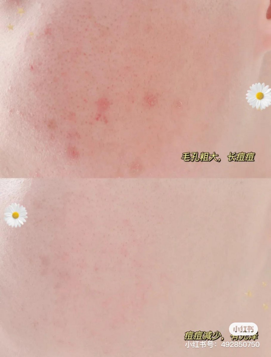 ✨ STRIDEX 绿色款水杨酸棉片 | RM26.20 >> 链接 这款水杨酸片比较适合油皮女生使用，内含0.5%水杨酸在刷酸类产品里面算是比较温和的，对消除闭口和痘痘都很有效。提醒女生们使用前先用几天时间稍微是在肌肤上先让皮肤有耐受度，不要一上来就直接湿敷太久，以免皮肤不耐受泛红敏感～