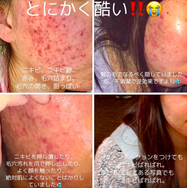 消不尽的痘痘让人超级抓狂,更崩溃的是试用过各种祛痘方法后依然无法把万恶痘痘抚平!日本女生 @ のぴちゃんNopi 曾经也面临相同问题,脸上一颗颗红肿痘痘不断冒头,甚至见了皮肤专科吃药还是无济于事。