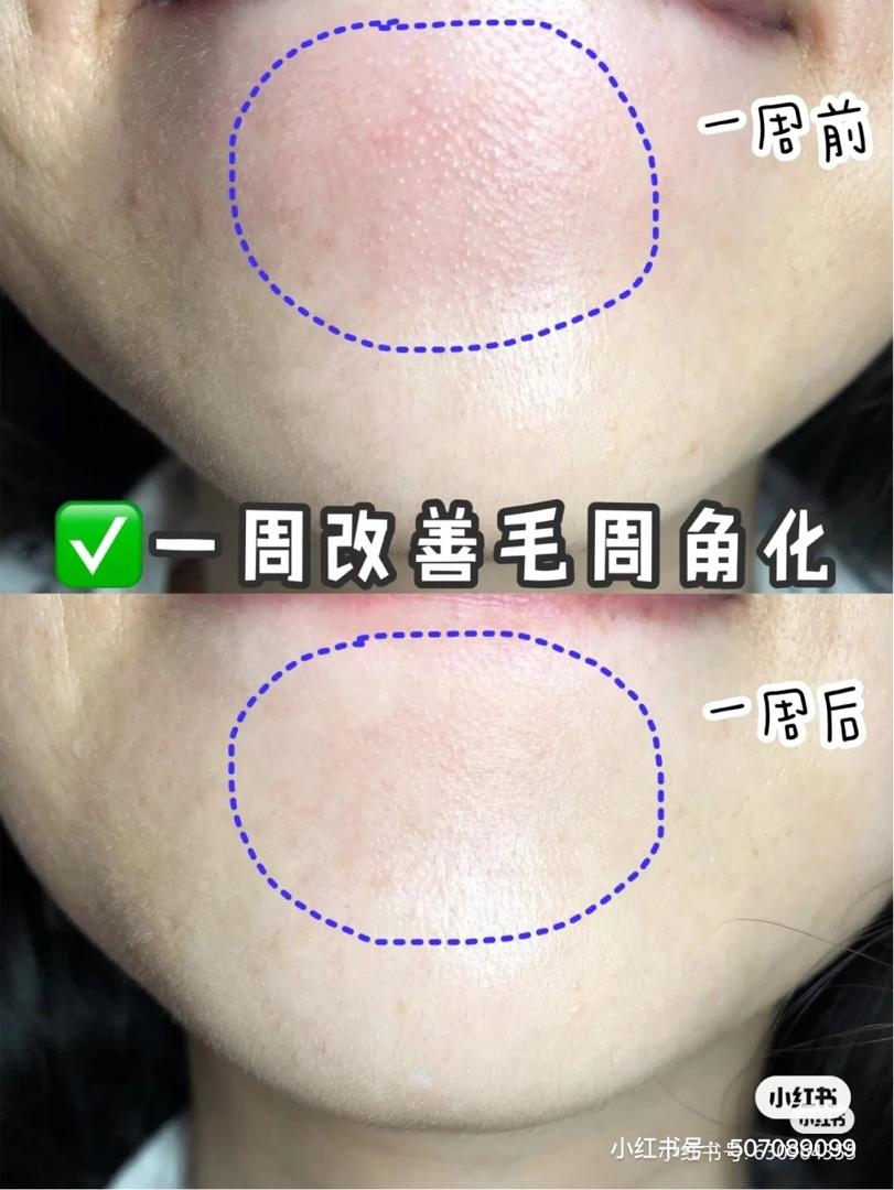 stridex 毛周角化
