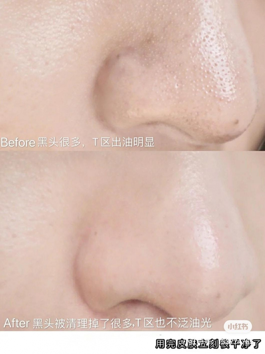 Kiehl's 白泥面膜 Rare Earth Deep Pore Cleansing Masque 被称为「黑头粉刺闭口吸尘机」的亚马逊白泥面膜有很强的吸附力和平衡油脂功效,其中还添加了库拉索芦荟舒缓保湿肌肤,良好清洁吸附脏污的同时也能避免刺激肌肤。 敷白泥面膜前先喷补水喷雾或拍上爽肤水,可以减少对皮肤的刺激;额头、鼻翼、下巴容易长粉刺的位置着重厚涂,5-8分钟后面膜半干微湿状态下就能清洗掉喽~手指用温水打湿、边打圈揉搓按摩边用温水洗净全脸。之后用棉花棒把浮出来的黑头粉刺去干净。最后敷个补水面膜或湿敷镇静功效化妆水即可。