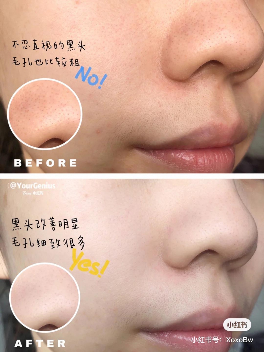 L'Oreal Paris Revitalift Crystal Micro Essence积雪草微精华露 银盖款积雪草微精华适合混合性、油性肌肤使用，作用包含调节肌肤水油平衡、有效改善暗沉粗糙疲劳肌肤，以及黑头、痘痘和闭口问题。质地清爽好吸收的这款微精华露中带酸，可以帮助角质代谢并修护肌肤；平时使用可以轻拍上脸按摩促进吸收，或者用化妆棉打湿后擦拭全脸进行二次清洁。>> 双十二买正装130ml送6支迷你装共132ml RM71.90 【点击查看促销详情】