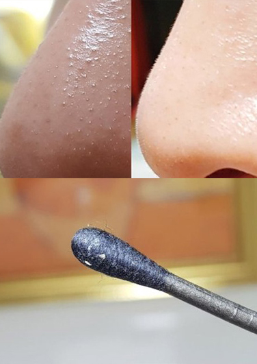 去黑头粉刺特搜好物 4 :One-day‘s you 黑头BYE BYE毛孔清洁液 这款小众但韩网上公认超好用的“清洁液”用法很简单、效果据说很惊人!首先清洁脸部,可以用温热毛巾热敷一下黑头粉刺堆积的位置打开毛孔,再用它打湿化妆棉湿敷5至10分钟。 把化妆棉揭掉后会看见脏脏的黑头粉刺瞬间“炸”出来浮在皮肤表层,用棉花棒清除掉再用清水洗净即可~