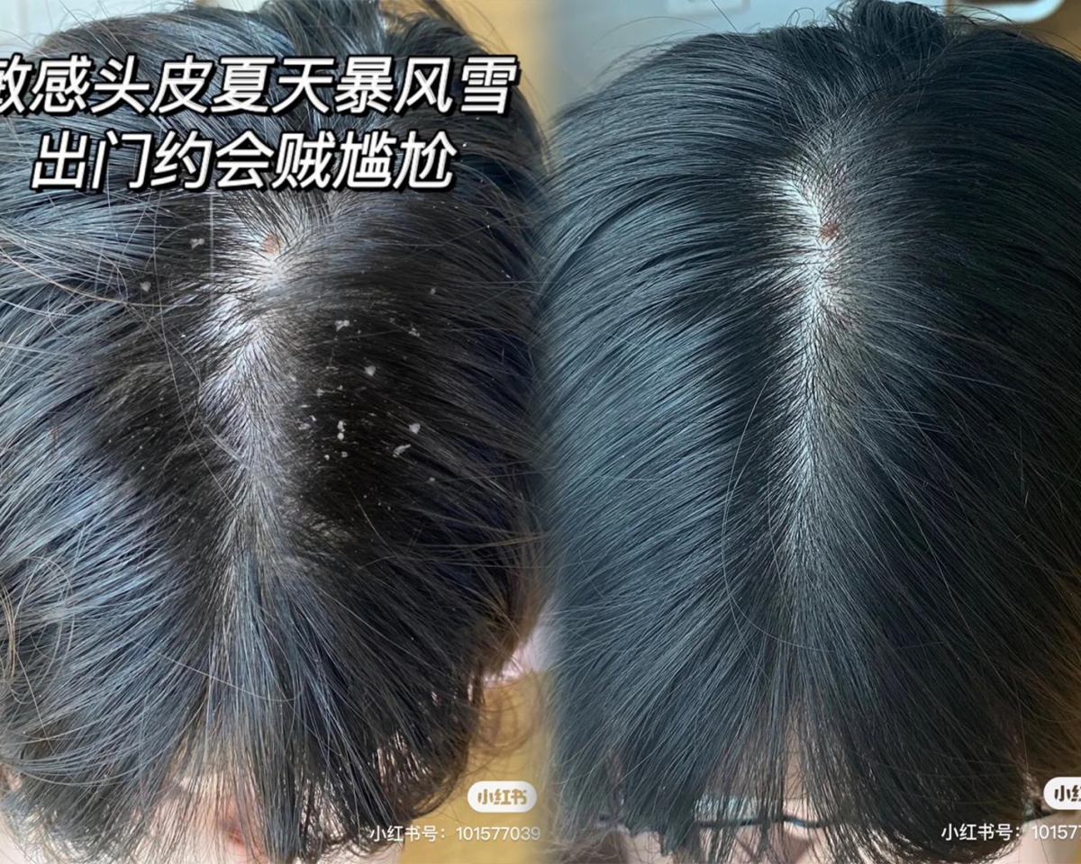 头皮屑_