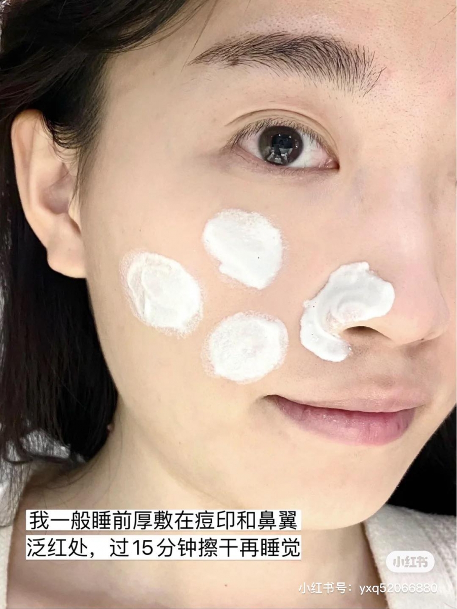 B5霜用途 # 3 :加速淡化痘印痘疤 痘痘肌肤可以点涂在新鲜红色痘印、或者已经开始干瘪下去的痘痘上,有助加速痘印淡化;不小心抠破的受损痘痘也可以点涂B5霜,加速伤口愈合。注意这款B5霜不适合敷在新生痘痘上哦~ B5霜用途 # 4 :修复刷酸不适肌肤 刷酸小白用量和选品NG、或者一不小心用了肌肤不耐受的含酸类护肤品的话,很容易引起肌肤泛红、痕痒、干燥起皮等问题;这类「刷酸翻车」状况下,建议可以用B5霜急救修复。敏感肌、混合肌和敏感肌可以直接厚涂,油肌女孩则建议可以先把B5霜挤在手心,轻揉乳化后上脸薄涂。