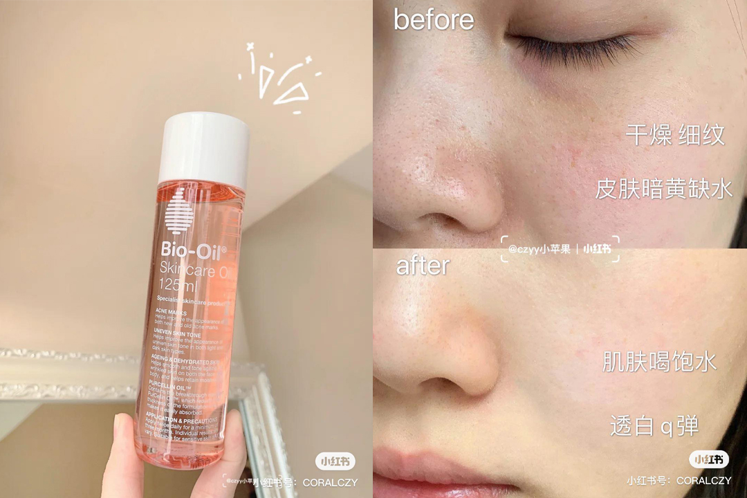 BIO OIL Skin Oil 保养油 BIO OIL保养油中蕴含多重植物萃取精华油,其中包括:镇静修复肌肤的金盏花油、主打抗菌修护收缩毛孔的薰衣草油、可抗炎镇静肌肤的甘菊油、舒缓肌肤促进新陈代谢的迷迭香油,以及淡化细纹紧致肌肤的维生素A、抗氧抗老维生素E等。不仅可以滋养全身皮肤、帮助淡化脸部痘印、预防和改善妊娠纹,还能用「以油溶油」原理溶解清除堵塞毛孔的黑头粉刺。