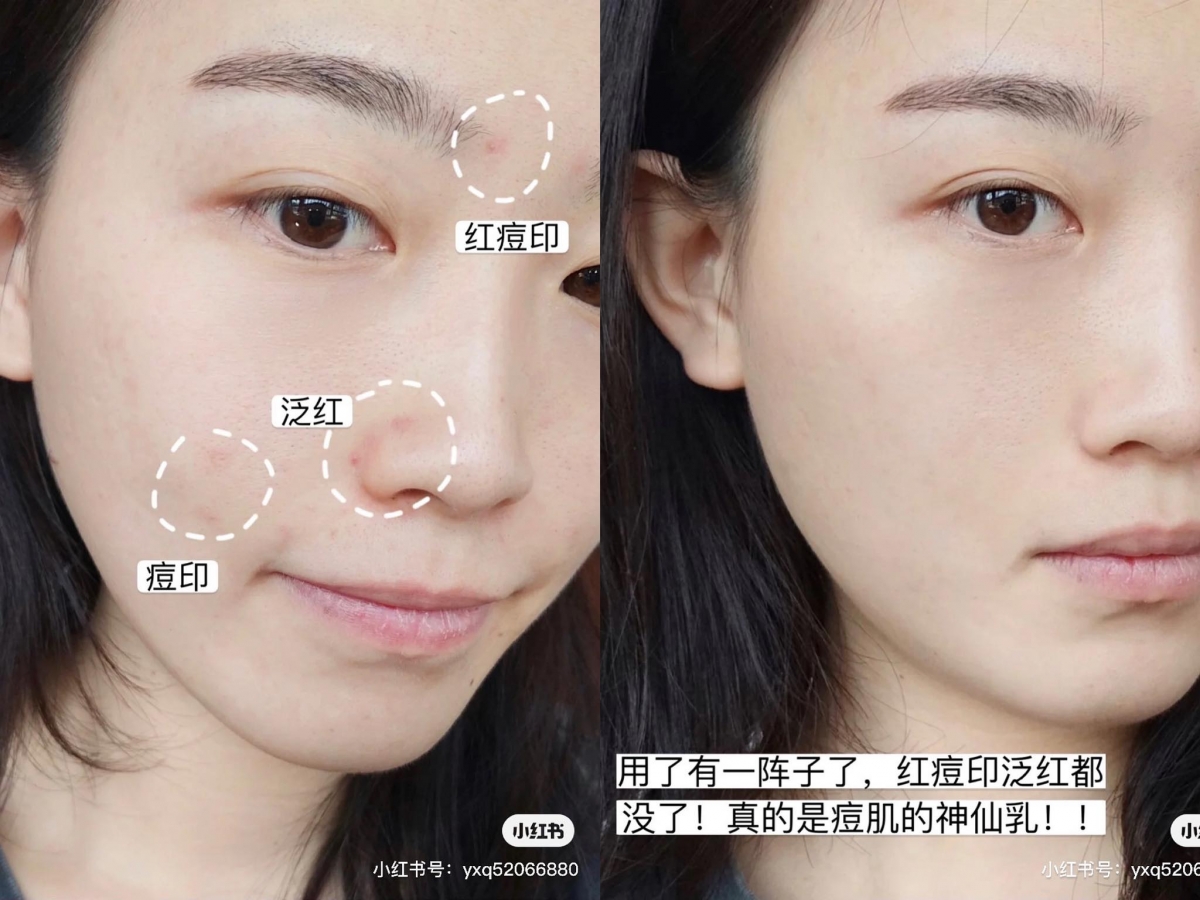 B5霜用途 # 3 :加速淡化痘印痘疤 痘痘肌肤可以点涂在新鲜红色痘印、或者已经开始干瘪下去的痘痘上,有助加速痘印淡化;不小心抠破的受损痘痘也可以点涂B5霜,加速伤口愈合。注意这款B5霜不适合敷在新生痘痘上哦~ B5霜用途 # 4 :修复刷酸不适肌肤 刷酸小白用量和选品NG、或者一不小心用了肌肤不耐受的含酸类护肤品的话,很容易引起肌肤泛红、痕痒、干燥起皮等问题;这类「刷酸翻车」状况下,建议可以用B5霜急救修复。敏感肌、混合肌和敏感肌可以直接厚涂,油肌女孩则建议可以先把B5霜挤在手心,轻揉乳化后上脸薄涂。