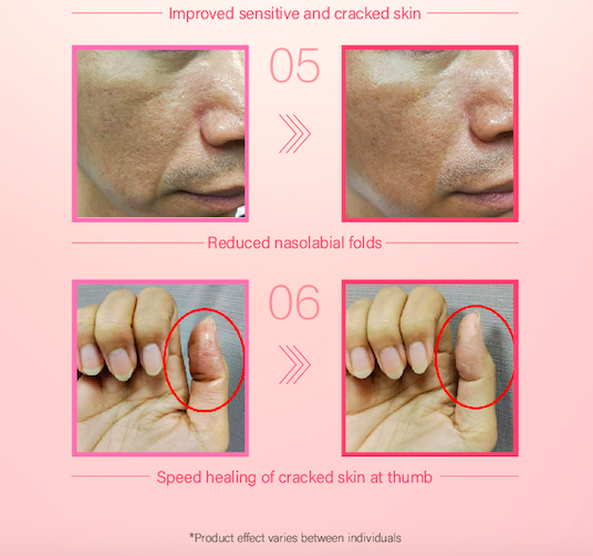 余仁生 nanollagen 前后对比