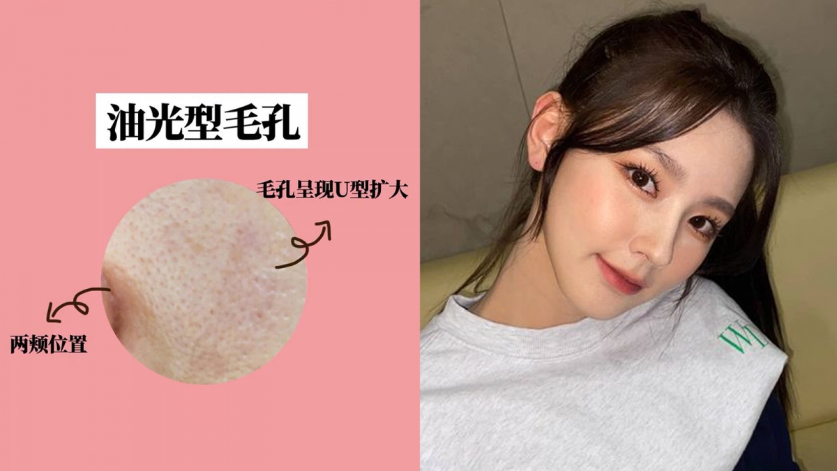 毛孔类型 3 ：油光型毛孔   形状属于U型的「油光型毛孔」常见于混合型肌肤和油性肌肤，聚集在频繁出油的T区和两颊，起因主要是油脂分泌过盛。  平日里建议少吃导致油脂分泌旺盛的油腻和辛辣重口味食物；在选择控油类护肤和清洁产品时，切记不要以为追求肌肤干爽太频密洗脸，更不要选择过于强效清洁的产品，否则水油失衡容易越洗皮肤越油！