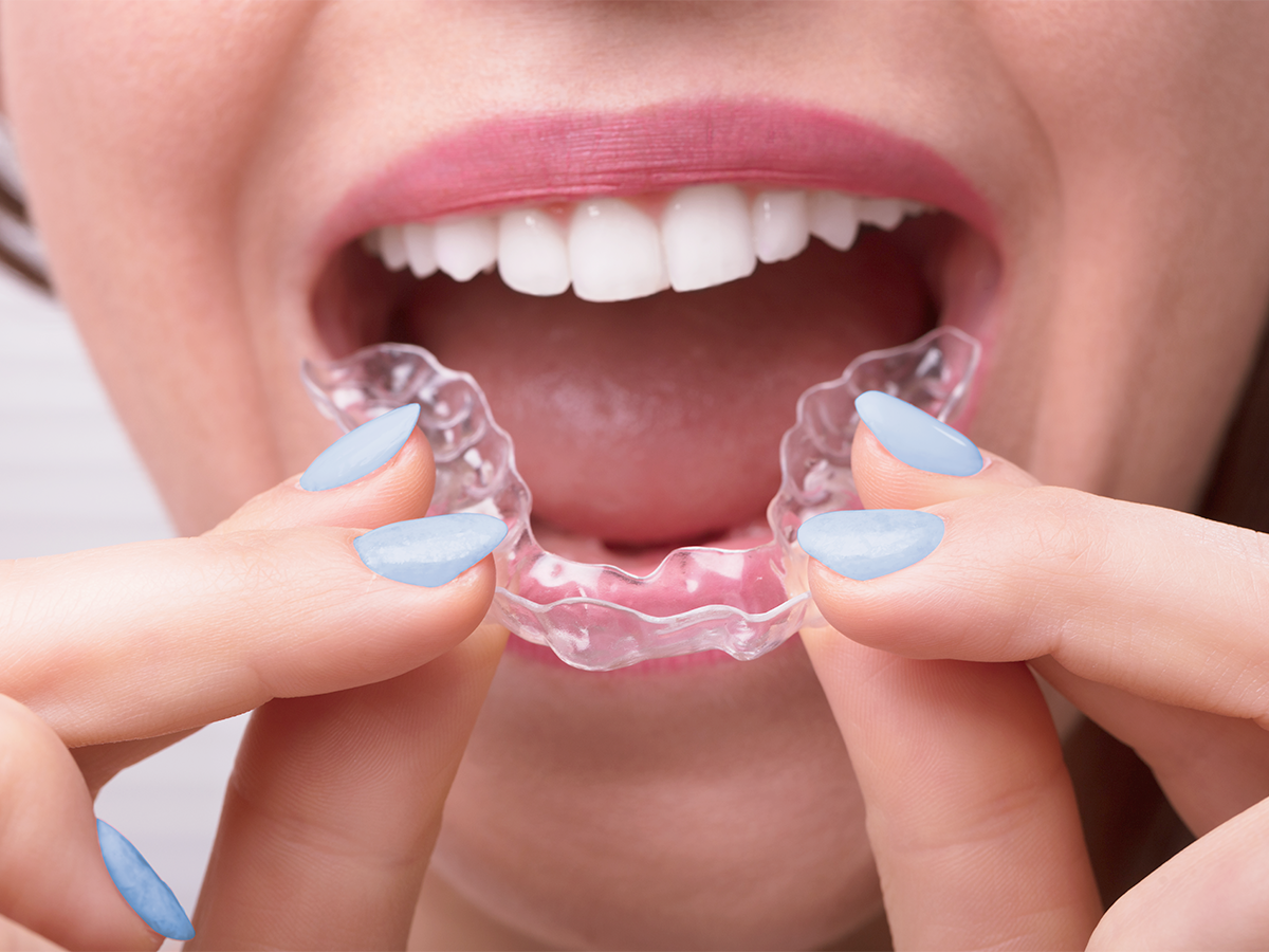 zenyum 隐形牙套优势