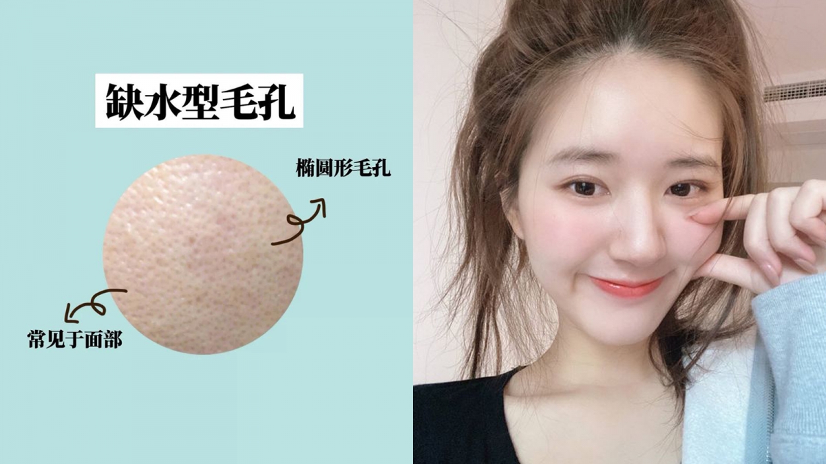 毛孔类型 1 ：缺水型毛孔   一般皮肤上最常见的「缺水型毛孔」特征包括：细看毛孔形状呈椭圆型，日常中皮肤比较容易脱皮起屑和泛红，问题主要源于皮肤含水量不足、干燥缺水。  改善缺水型粗大毛孔最基础的做法是，一定要多喝水、确保身体含水量充足。护肤品部分，除了要多挑选保湿补水类型，也别忘了使用具备「锁水」功能的产品，将注入角质层的水分牢牢锁住。提供肌肤密集保湿修护的「面膜」也是很棒的选择。
