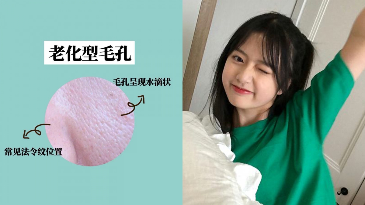 毛孔类型 4 ：老化/衰老型毛孔   衰老型毛孔形状偏长形、水滴形，常聚于法令纹附近的位置，一般因肌肤老化、胶原断裂流失导致皮肤松弛下垂和粗糙干燥所形成；平日里没有好好卸妆和涂抹防晒，都会促成老化型毛孔加速形成！    想要预防这类顽固毛孔的形成，一定要趁早注重防晒和卸妆；建议改善方法包括：内服外用补充胶原蛋白，以及选用抗氧抗老、紧致功效的护肤品。
