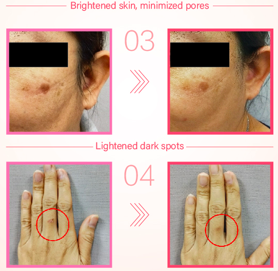 before after 胶原蛋白肽