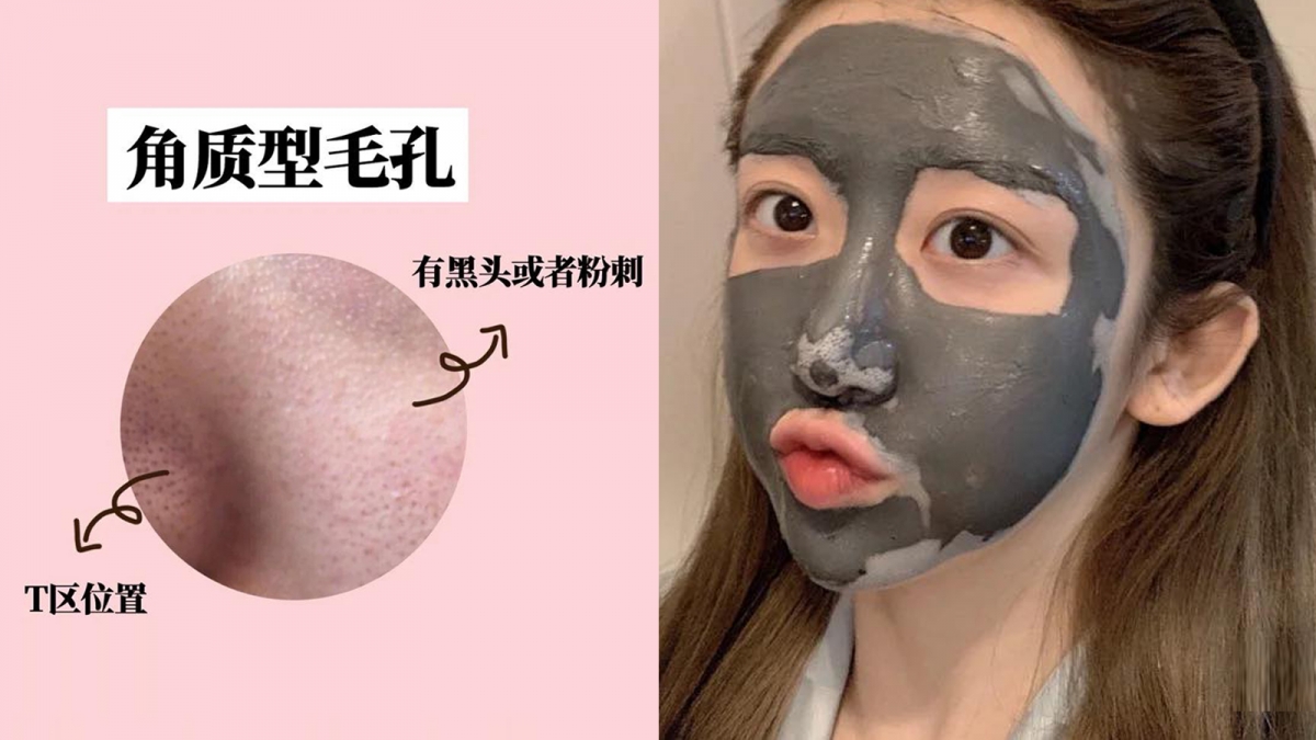 毛孔类型 2 ：角质型毛孔   和油光型毛孔一样常见于T区部位，但角质型毛孔稍有不同，其中会藏有顽固难清理的黑头粉刺，伴随而来的还有皮肤颗粒感明显、肤色暗沉无光问题。  皮肤清洁不彻底以致毛孔堵塞、压力过大、肌肤角质层增厚导致新陈代谢不良，都是角质型毛孔形成的起因。建议改善方法是，不要一直用手指乱挤粉刺黑头，以免毛孔越撑越大。另外也要记得定期做好去角质工作疏通毛孔，敷清洁面膜或使用去角质洁面产品前，可以先用毛巾热让毛孔敞开，之后用打圈按摩搓揉的手法进行清洁。去完角质不要忘了涂抹具备镇静肌肤功效的护肤品哟～