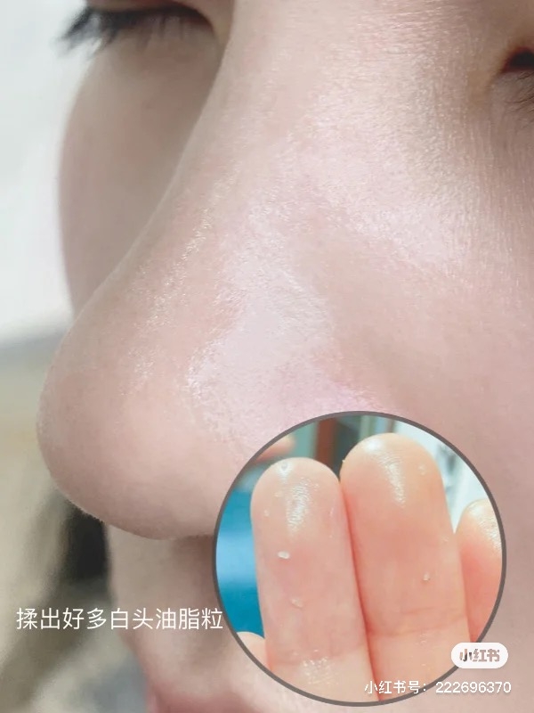 步骤(三)以油溶油 完成清洁泥面膜步骤后,可以使用油类护肤品如荷荷巴油、美容油等,在鼻头、两颊、下巴等经常长粉刺黑头的位置轻轻打圈按摩,「以油溶油」将藏在毛孔底下不易清干净的黑头粉刺「连根清走」。按摩的时候会明显看到很多脏东西从毛孔里被清出来;完成后用打湿过的热毛巾擦拭掉保养油。