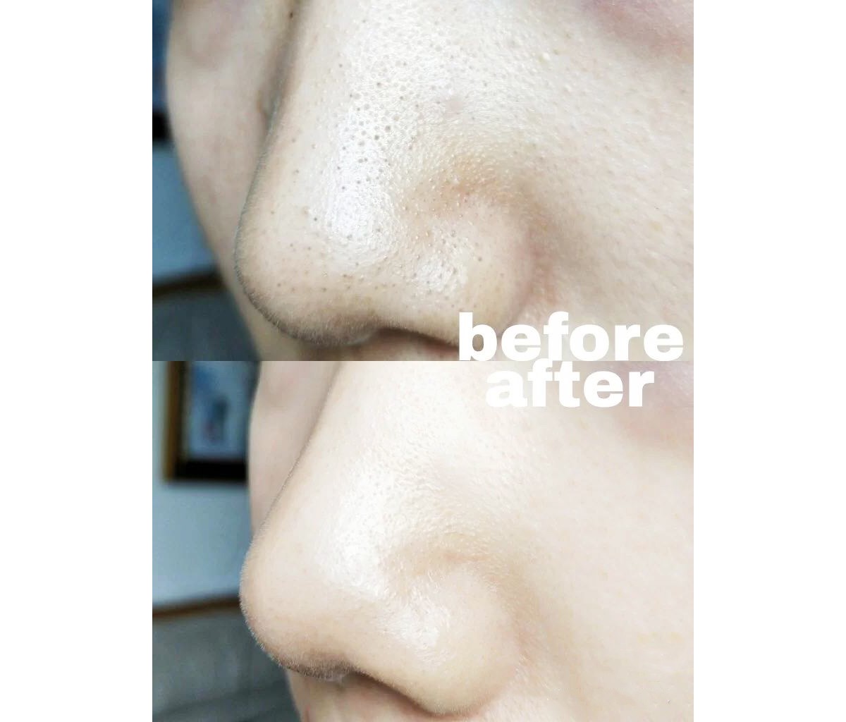 给被黑头粉刺占据的鼻头尝试过各种清洁方法,但密密麻麻的点点这边厢刚清除干净,没几天又打回原形...素颜没自信、化妆浮粉严重超不服贴(哭)如果你也有草莓鼻困扰、试过很多方式都无法和黑头粉刺说分手,下面这组在日本SNS上被疯传、网民赞爆是「凌虐毛孔脏东西」的1+1组合,或许可以帮到你!