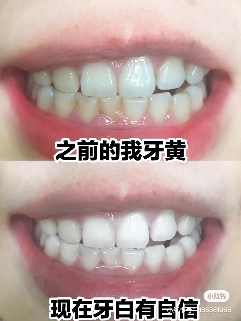 美白牙齿 6