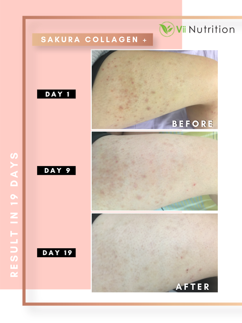 不少水水网友们坚持服用Sakura Collagen+都认证「效果肉眼可见」!除了脸部肌肤从视觉上看、摸起来的触感都有感状态改善很多,对身体肌肤也有莫大帮助~ 持续使用9天左右,腿上擦过很多保养都不见改善的「粗糙鸡皮颗粒」开始渐渐褪去; 坚持3个星期左右,皮肤触感变嫩滑;