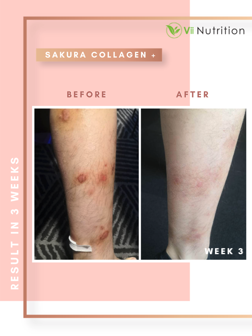 持续使用约3星期后,原本免疫力不好导致稍微弄伤就很容易留疤的皮肤,愈合力比以前好很多,原有的疤痕也明显淡化了。