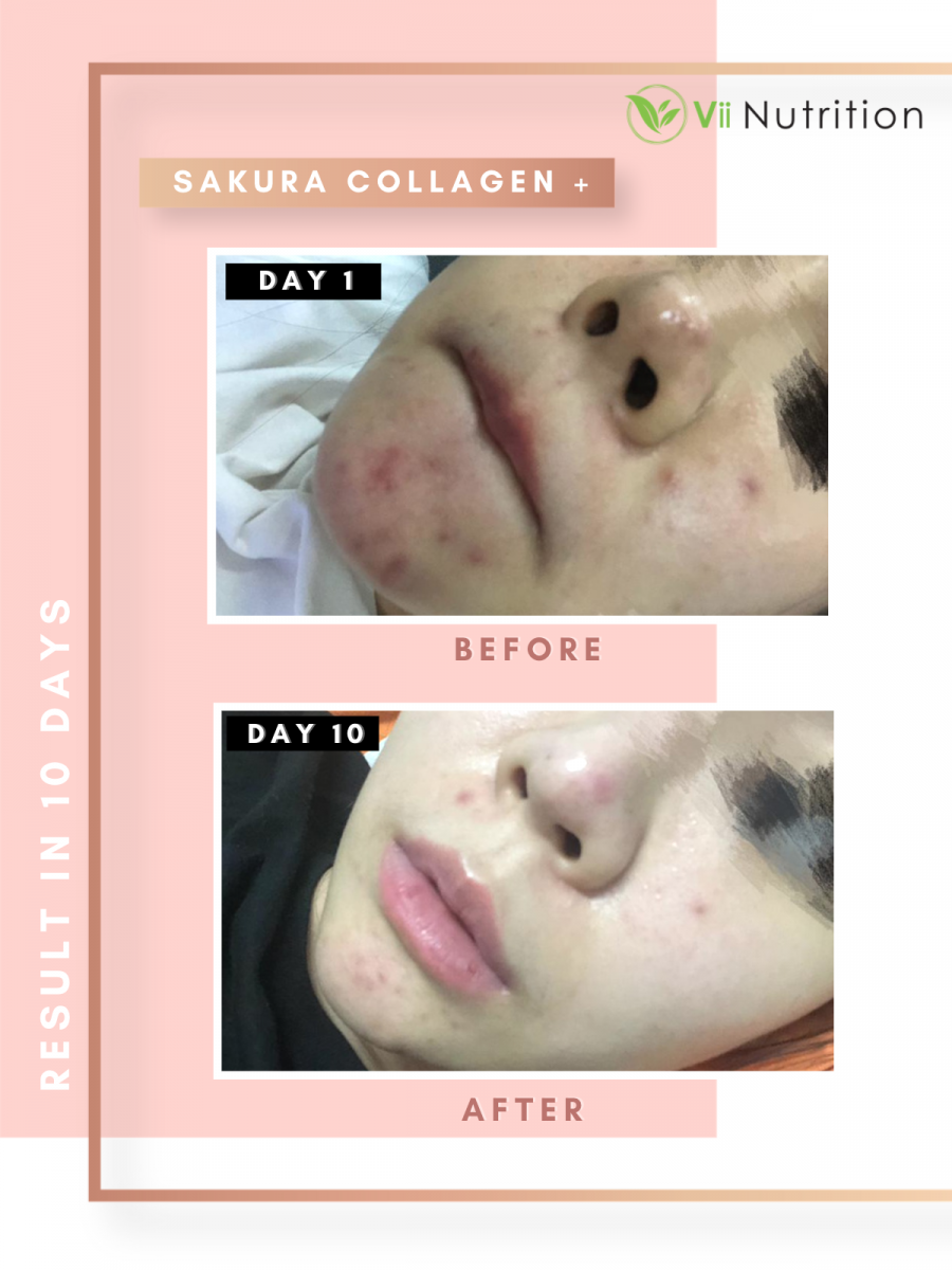 持续使用8星期有效淡化脸上斑点; 持续使用12星期疤痕有所改善。