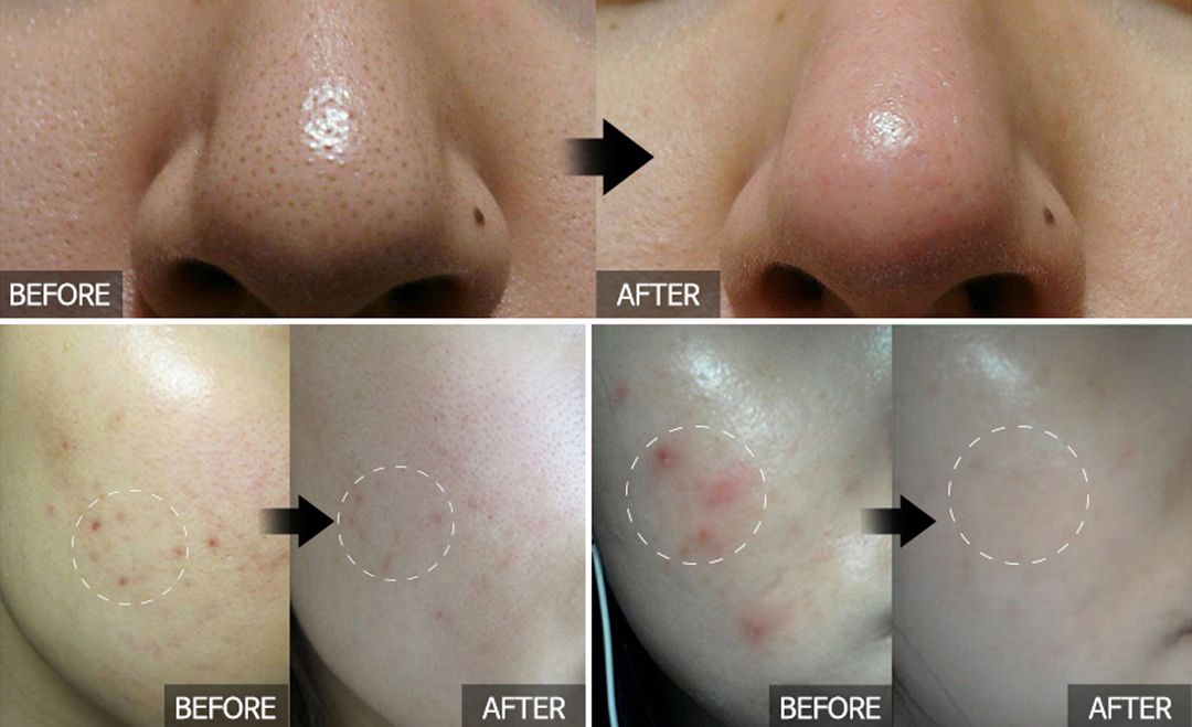 此外,这款精华也能帮助促进老废角质代谢使肌肤焕然一新,同时有感改善黑头和肌肤松弛问题~美编不藏私小秘诀分享:这款精华搭配同系列A+ Cream面霜,亮白效果真的绝绝子真心不骗~