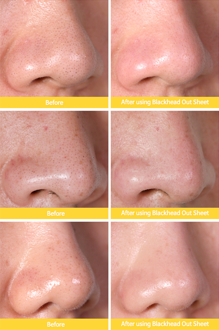 06 / TIA’M Blackhead Out Sheet [NEW] 打击黑头问题绝对不能“以暴制暴”！太暴力的清除黑头/闭口/粉刺方式如：用手或小工具挤压/戳、用黏着性很高的撕拉式鼻贴，反倒容易让肌肤屏障受损，稍有不慎还会有毛孔被撑大的风险！主打「敷一敷松动+清出顽固黑头」的TIA’M Blackhead Out Sheet，一罐中有35片浸透无患子萃取和BHA成分的圆形棉片，不仅可以在不伤害肌肤的前提下，轻柔地将藏在毛孔里的“脏东西”清除干净，还具备镇静皮肤和紧致收缩毛孔功效。