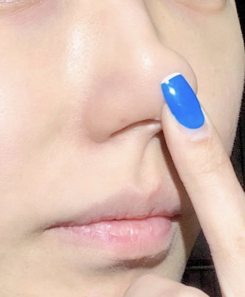 用温和的荷荷巴油揉搓脸颊和鼻头的部位，过程中不但可以搓出黑头粉刺，还可以软化肌肤角质改善毛周角化的问题。