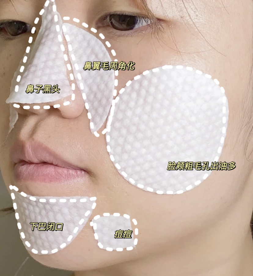 选择水杨酸棉片相对来说更加温和，先用纹路面来回擦拭脸颊和鼻头，再用光滑面师傅5分钟。最后可以是用棉棒或牙线，轻轻的刮下毛孔里的脏东西就搞定啦！