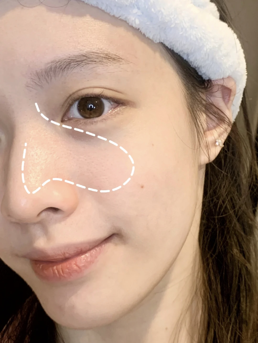 先使用蒸脸仪或者热毛巾敷在脸上5分钟，帮助打开肌肤的毛孔让皮肤变软