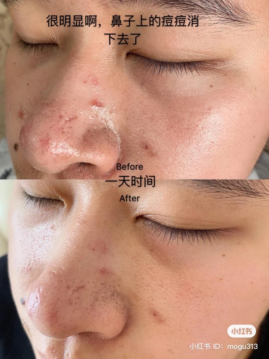 全天然的温和祛痘配方,不管什么肤质使用都毫无负担~早晚使用加上做好保湿工作,相信定能改善频繁长痘的困扰。