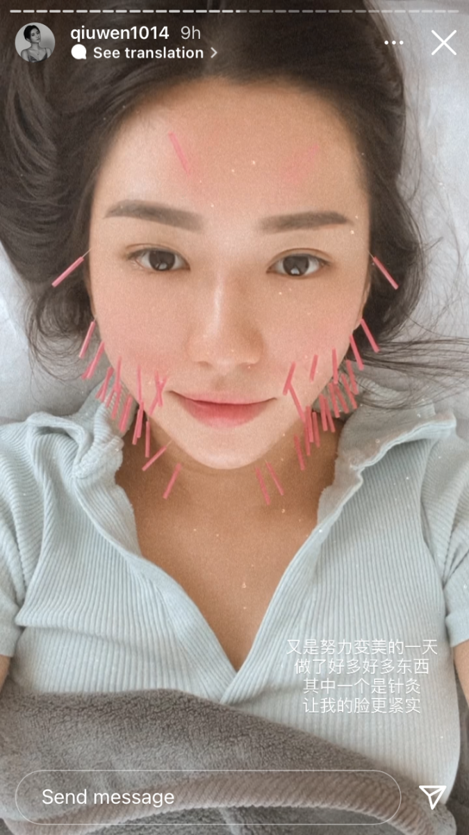 秋雯曾在限时动态晒过一张满脸扎满针的图像「又是努力变美的一天,做了很多东西,其中一个是针灸,让我的脸更紧实」