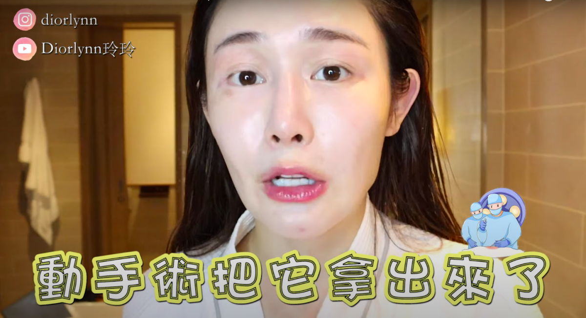 「但是我的鼻子呢在前一年,我就动手术把它拿出来了」