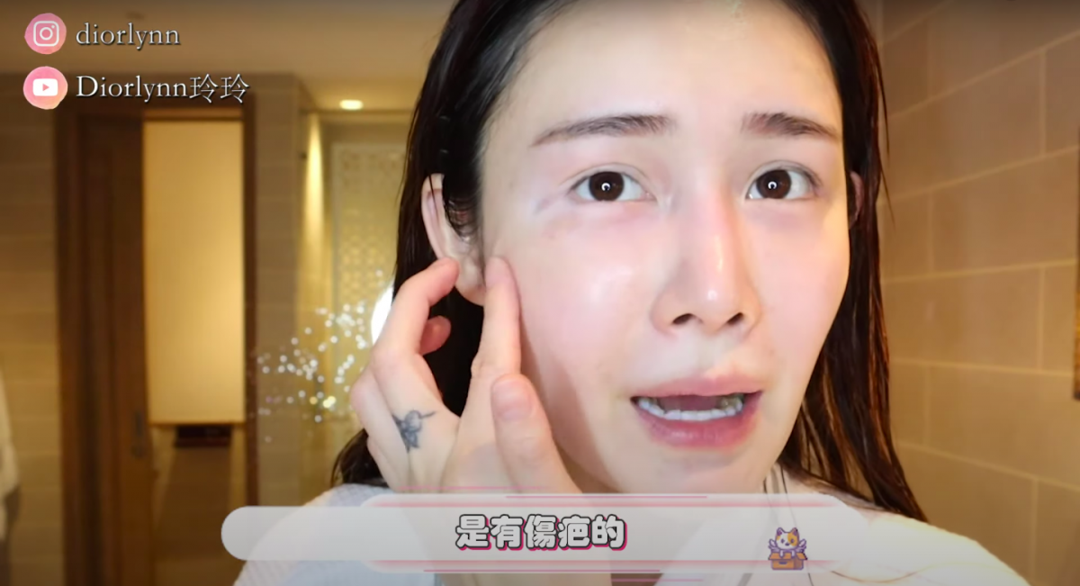Diorlynn也大方展露眼角下的伤疤,她解释道这是10年前遭隐翅虫咬到的疤痕。