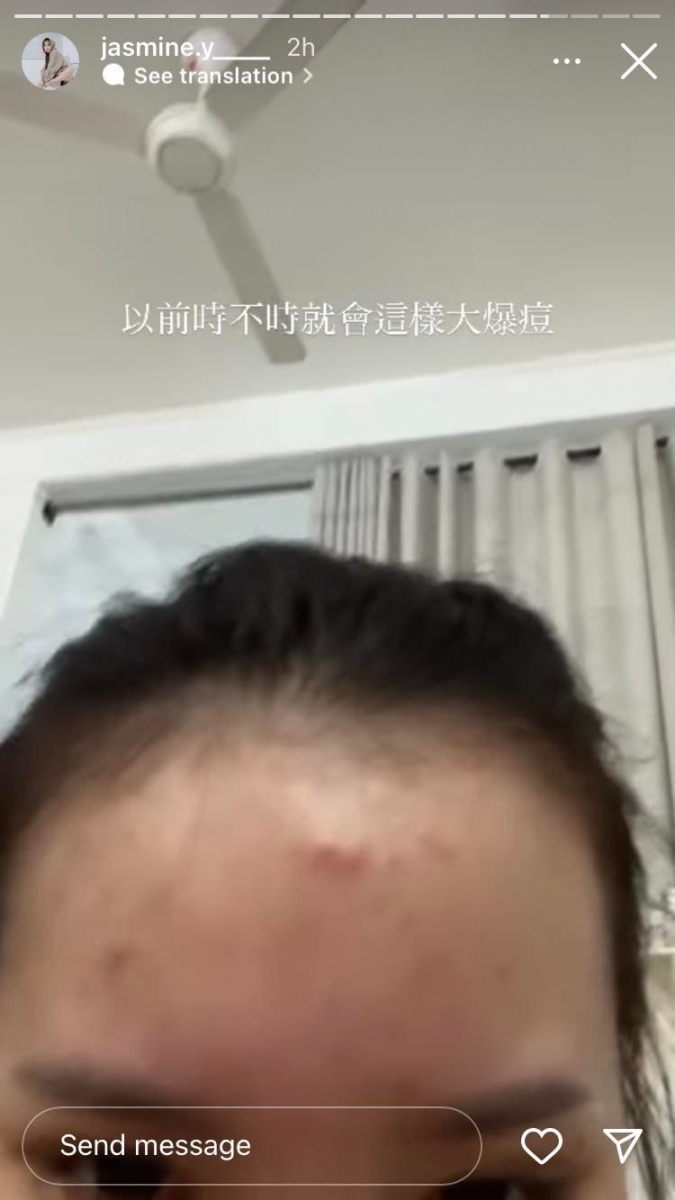 说到抗痘的心路历程香米刚开始也挺无奈