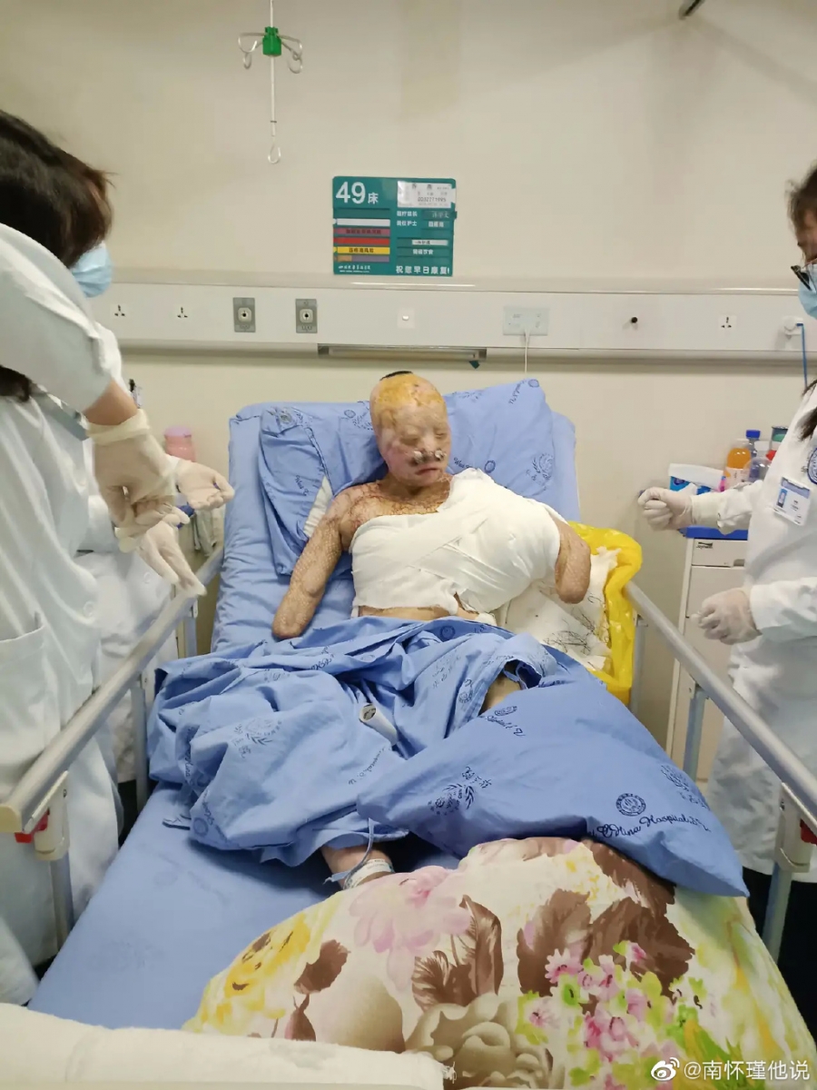 经诊断乔燕全身 48%的面积被烧伤,烧伤程度是伤及皮肤全层的「三度烧伤」