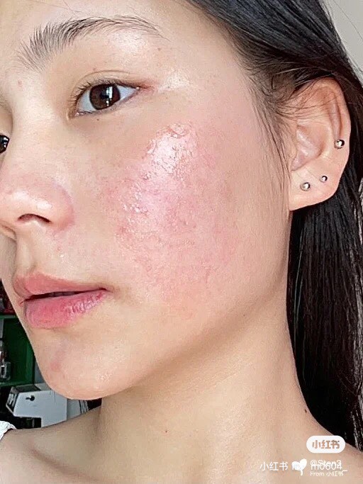一抹消炎祛痘还你健康无暇的白瓷肌