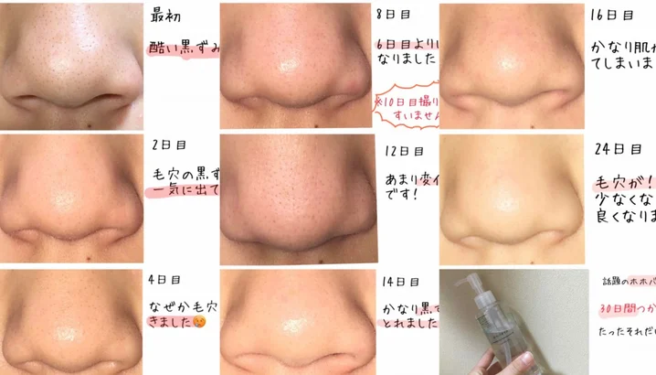 持续进行数次就发觉黑头慢慢被清出,鼻子就能像“白煮蛋”一样细嫩,看不到黑头粉刺和毛孔啦!